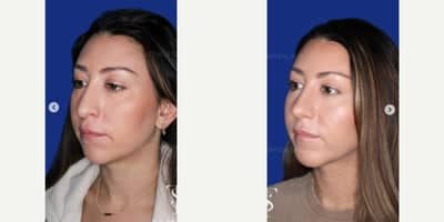 Case 9116 - 35-44 year old woman treated with Revision Rhinoplasty, Chin Implant