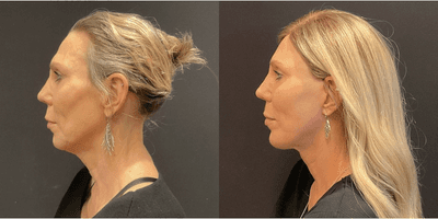Case 9173 - Woman treated with Facelift, Neck Lift, Chin Implant
