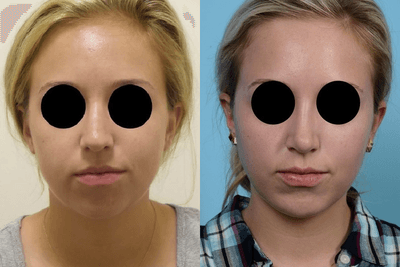 Case 9182 - Woman treated with Chin Implant