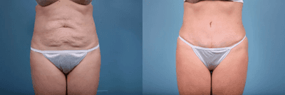 Case 92 - Woman treated with Tummy Tuck