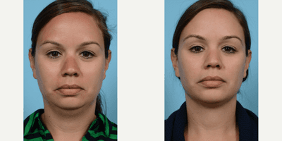 Case 9224 - 25-34 year old woman treated with Chin Implant and Sub-Mental Liposuction