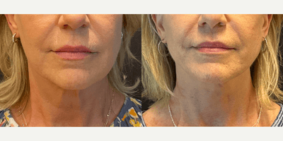 Case 9255 - Woman treated with Neck Lift