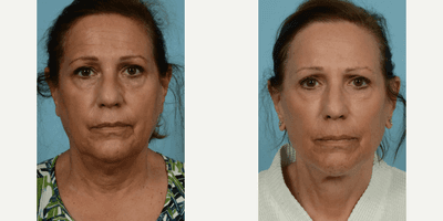 Case 9268 - Woman treated with Facelift, Neck Lift