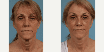 Case 9281 - 55 year old woman treated with Facelift, Neck Lift