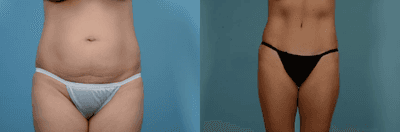 Case 93 - Woman treated with Tummy Tuck