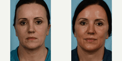 Case 9303 - Woman treated with Facelift, Neck Lift