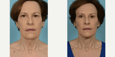 Case 9315 - Woman treated with Facelift, Neck Lift