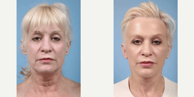Case 9320 - 54 year old woman treated with Facelift, Neck Lift