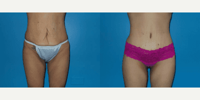 Case 94 - Woman treated with Tummy Tuck