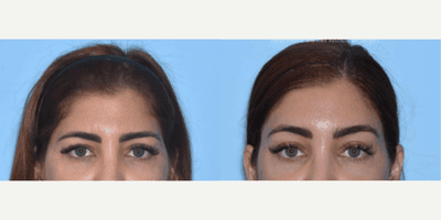 Case 9453 - Woman treated with Brow Lift