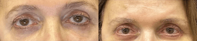 Case 9455 - 68 year old woman treated with Brow Lift