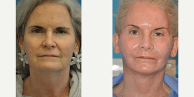Case 9456 - Woman treated with Brow Lift