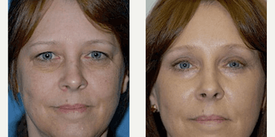 Case 9457 - Woman treated with Brow Lift
