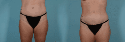 Case 95 - Woman treated with Tummy Tuck