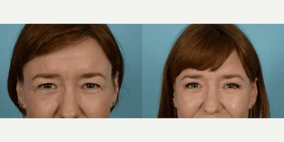 Case 9508 - 43 year old woman treated with Brow Lift