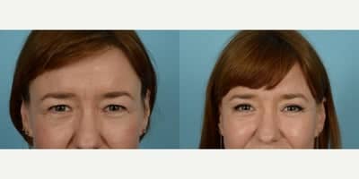 Case 9509 - 45-54 year old woman treated with Brow Lift