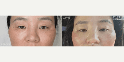 Case 9575 - Woman treated with Thread Lift