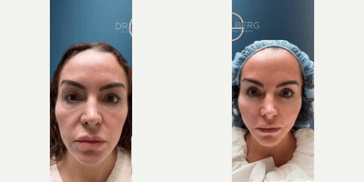 Case 9577 - Woman treated with Thread Lift