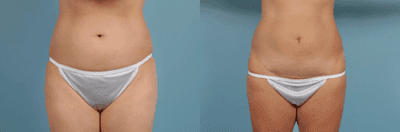 Case 96 - Woman treated with Tummy Tuck