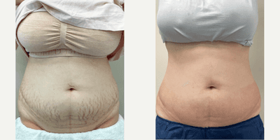Case 9676 - 25-34 year old woman treated with Halo Laser