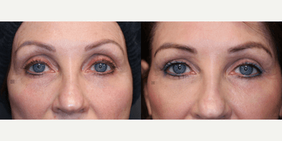 Case 9726 - Fat transfer and laser resurfacing.