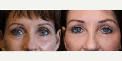 Case 9727 - Fat transfer and laser resurfacing.