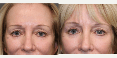 Case 9728 - Revision eyelid surgery and lip lift
