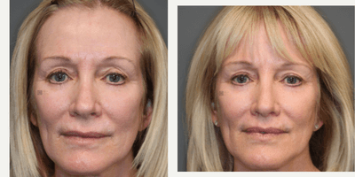 Case 9729 - Revision eyelid surgery and lip lift