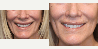 Case 9730 - Revision eyelid surgery and lip lift