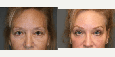 Case 9731 - Enigmalift brow and upper eyelids.