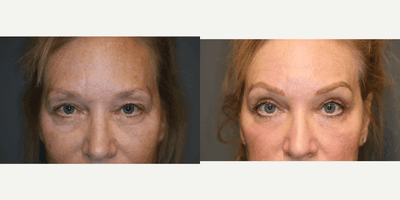 Case 9732 - Enigmalift brow and upper eyelids.