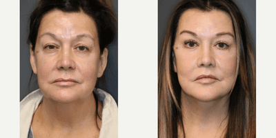 Case 9736 - Enigmalift full facial rejuvenation.