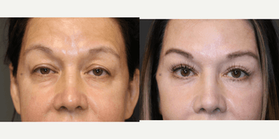 Case 9737 - Enigmalift full facial rejuvenation.