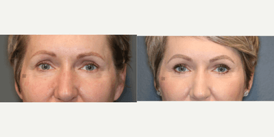 Case 9741 - Stem cell rich fat transfer and laser.