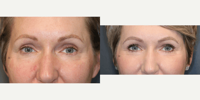 Case 9742 - Stem cell rich fat transfer and laser.