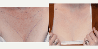 Case 9743 - Chest Rejuvenation