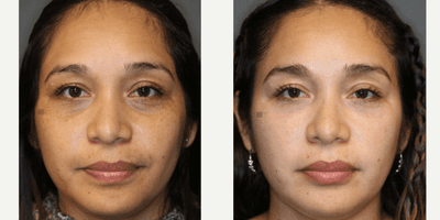 Case 9744 - Syringoma Laser Treatment and Lower Lid Filler