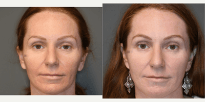 Case 9745 - Acne scars and fat transfer.