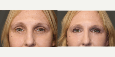 Case 9746 - Enigmalift and Fat Grafting with Laser