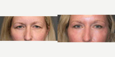 Case 9747 - Brow, Upper Lid, Skin Rejuvenation