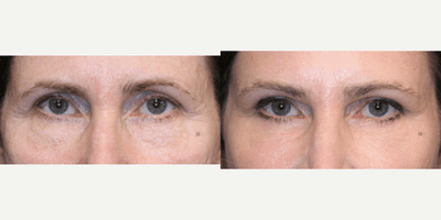 Case 9749 - Enigmalift Upper and Lower Eyelid Surgery