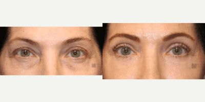 Case 9750 - Enigmalift Upper and Lower Eyelid Surgery.