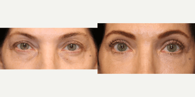 Case 9751 - Enigmalift Upper and Lower Eyelid Surgery