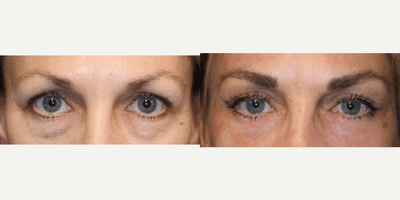 Case 9752 - Enigmalift Upper and Lower Eyelids