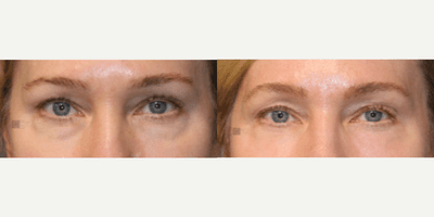 Case 9753 - Enigmalift Scarless Lower Eyebag Removal and Laser
