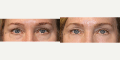 Case 9754 - Enigmalift Scarless Lower Eyebag Removal and Laser