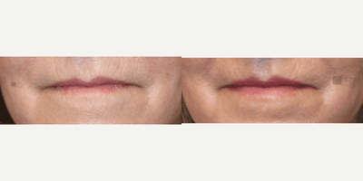 Case 9755 - Deep Plane Lip Lift and Laser