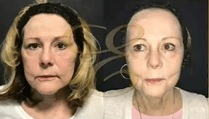 Case 9790 - Woman treated with Laser Resurfacing