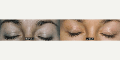 Case 9791 - Woman treated with Laser Resurfacing