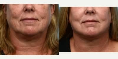 Case 9794 - 65-74 year old woman treated with Laser Resurfacing